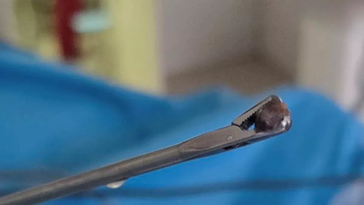 Новочебоксарские врачи прооперировали бойца СВО, получившего ранение от взрыва мины