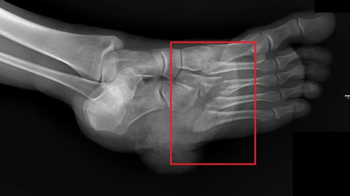 Новочебоксарка чуть не потеряла стопу во время работы по дому