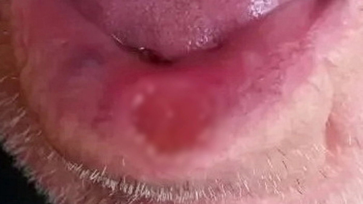 Пожилой новочебоксарец получил шанс на выздоровление: провели допобследование на онкологию